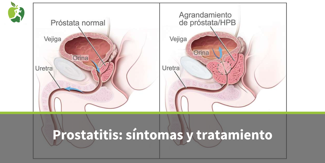 Prostatitis: qué es, causas, síntomas y tratamientos