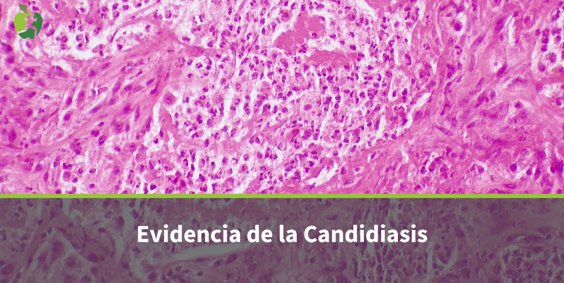Candidiasis: Un Enfoque Integrativo Basado en la Evidencia