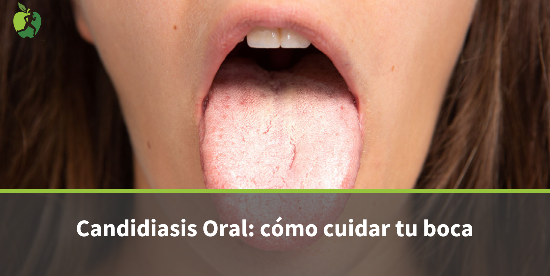 Candidiasis Oral: Síntomas Causas y cómo cuidar la boca